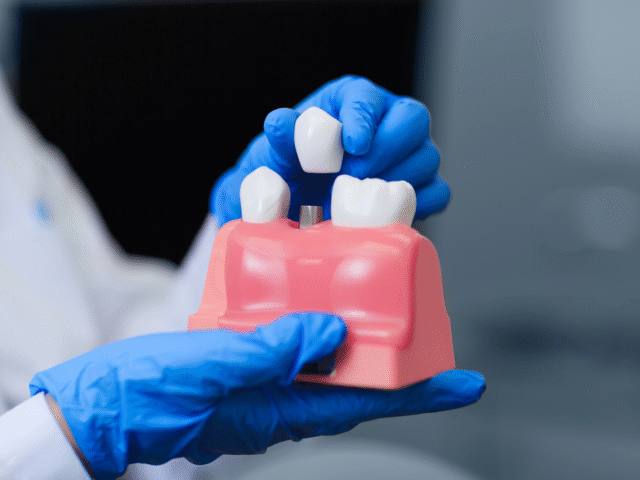 How to Maintain Dental Implants for Long-Lasting Results