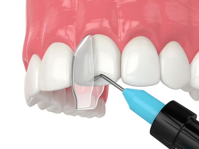 How Can Cosmetic Bonding Improve Your Smile?