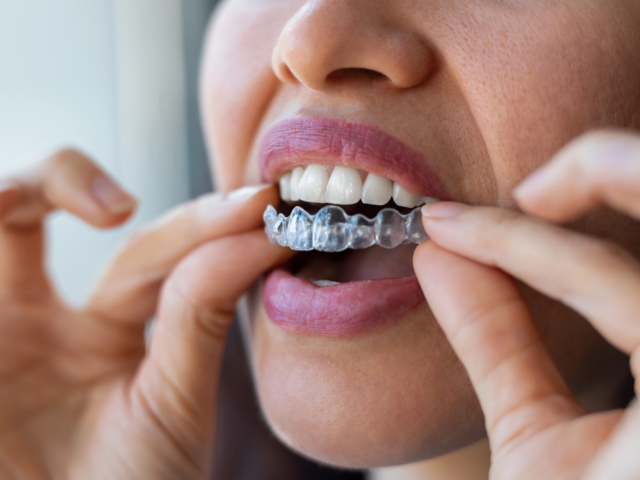 Are There Effective Alternatives to Traditional Braces?