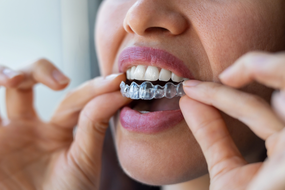 Invisalign North Raleigh
