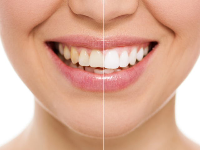 Does Professional Teeth Whitening Provide Lasting Results?